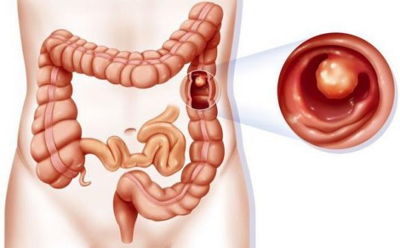Tác hại của rượu bia, Rượu bia gây bệnh