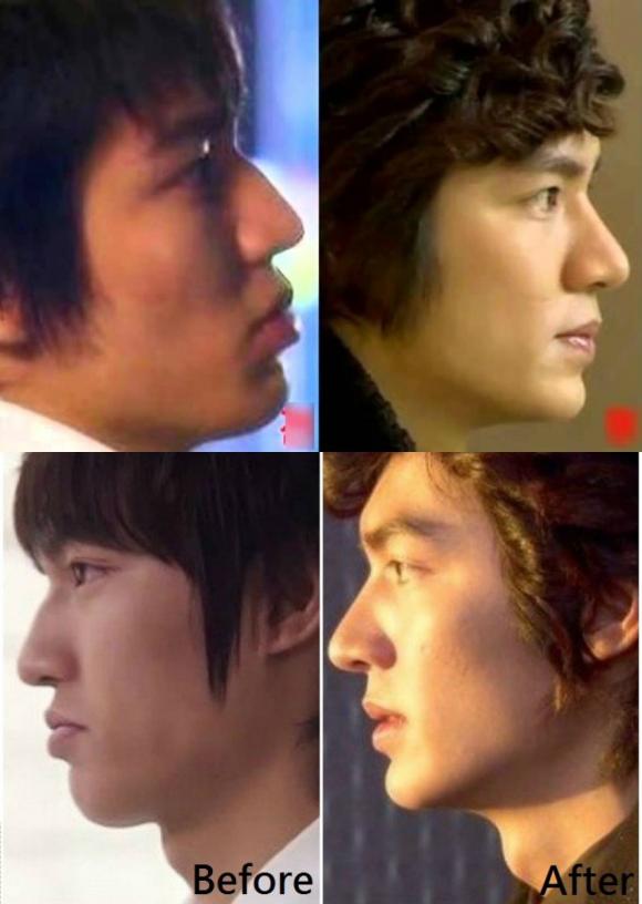 lee min ho, phẫu thuật thẩm mỹ, sao hàn