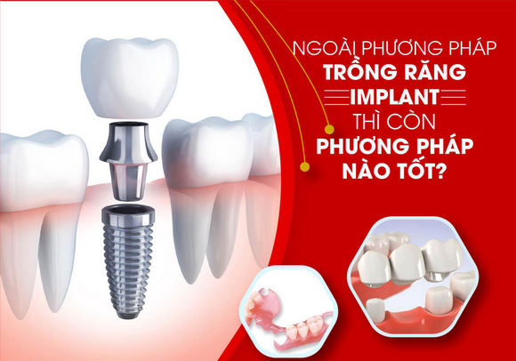 Nha khoa đông nam, trồng răng Implant, Răng sứ, Răng giả tháo lắp