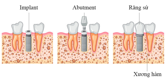 Nha khoa đông nam, trồng răng Implant, Răng sứ, Răng giả tháo lắp