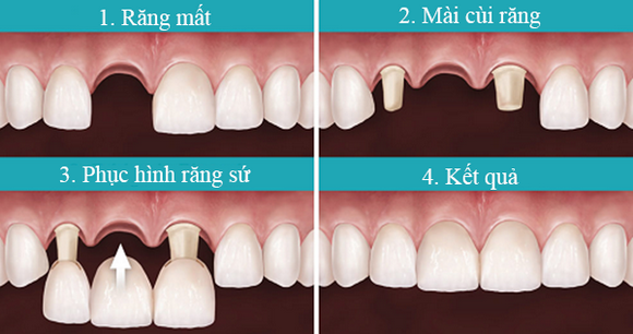 Nha khoa đông nam, trồng răng Implant, Răng sứ, Răng giả tháo lắp