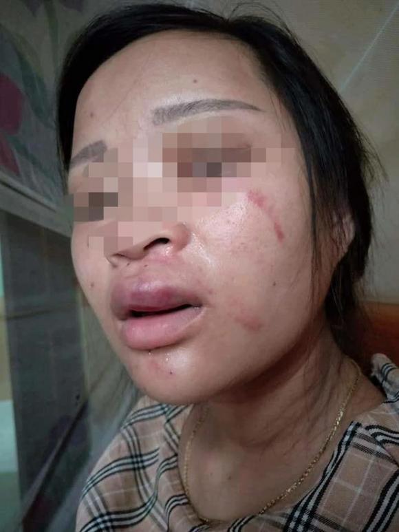 Thai phụ bị chồng đánh, bạo lực gia đình, tin nóng