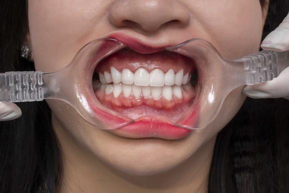 Những hiểu lầm tai hại về răng sứ thẩm mỹ