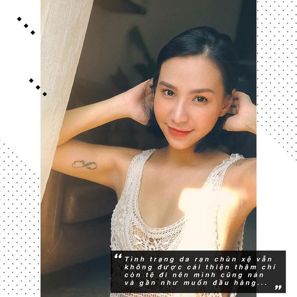 Quỳnh Trâm, Xóa rạn da bằng công nghệ Filas, Xóa rạn da không cần phẫu thuật thẩm mỹ