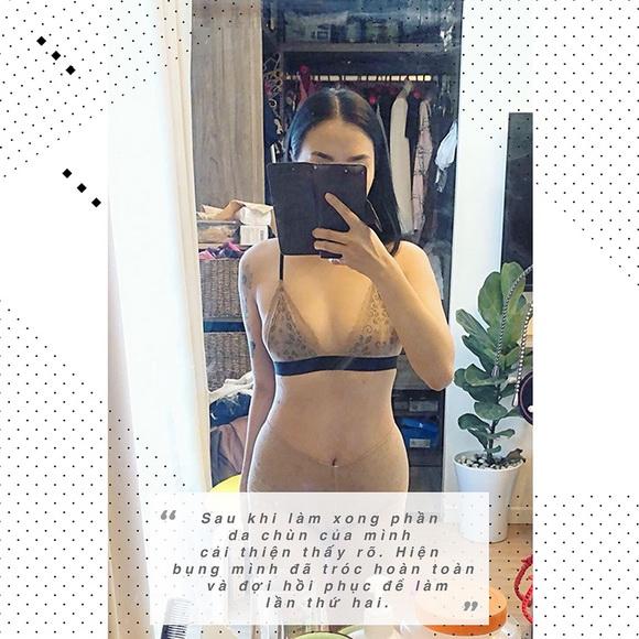 Quỳnh Trâm, Xóa rạn da bằng công nghệ Filas, Xóa rạn da không cần phẫu thuật thẩm mỹ