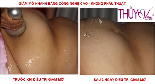 Thủy Venus,Thủy Venus khuyến mãi,dịp 8/3,phẫu thuật giảm mỡ