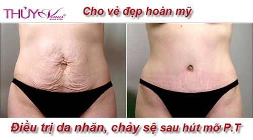 Thủy Venus,Thủy Venus khuyến mãi,dịp 8/3,phẫu thuật giảm mỡ