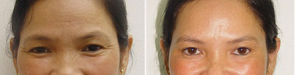 căng da vùng mắt,xóa nhăn vùng mắt,trẻ hóa vùng mắt,lão hóa vùng mắt,nếp nhăn,vết chân chim,bọng mỡ thừa