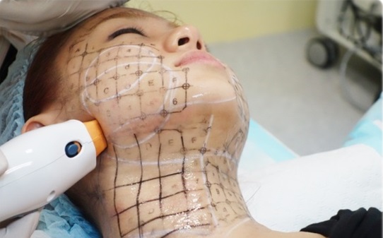 làm đẹp, trẻ hóa da, trẻ hóa da với Thermage
