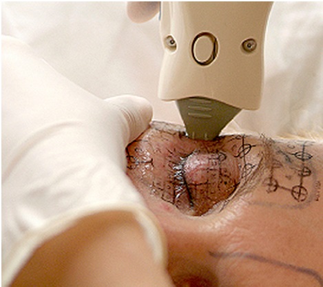 làm đẹp, trẻ hóa da, trẻ hóa da với Thermage